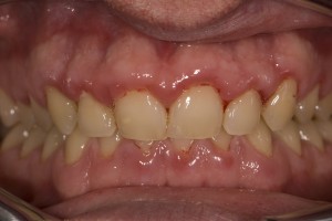 Gingivitis